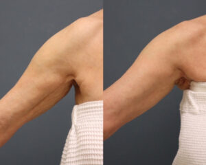 Arms RF Microneedling Hover