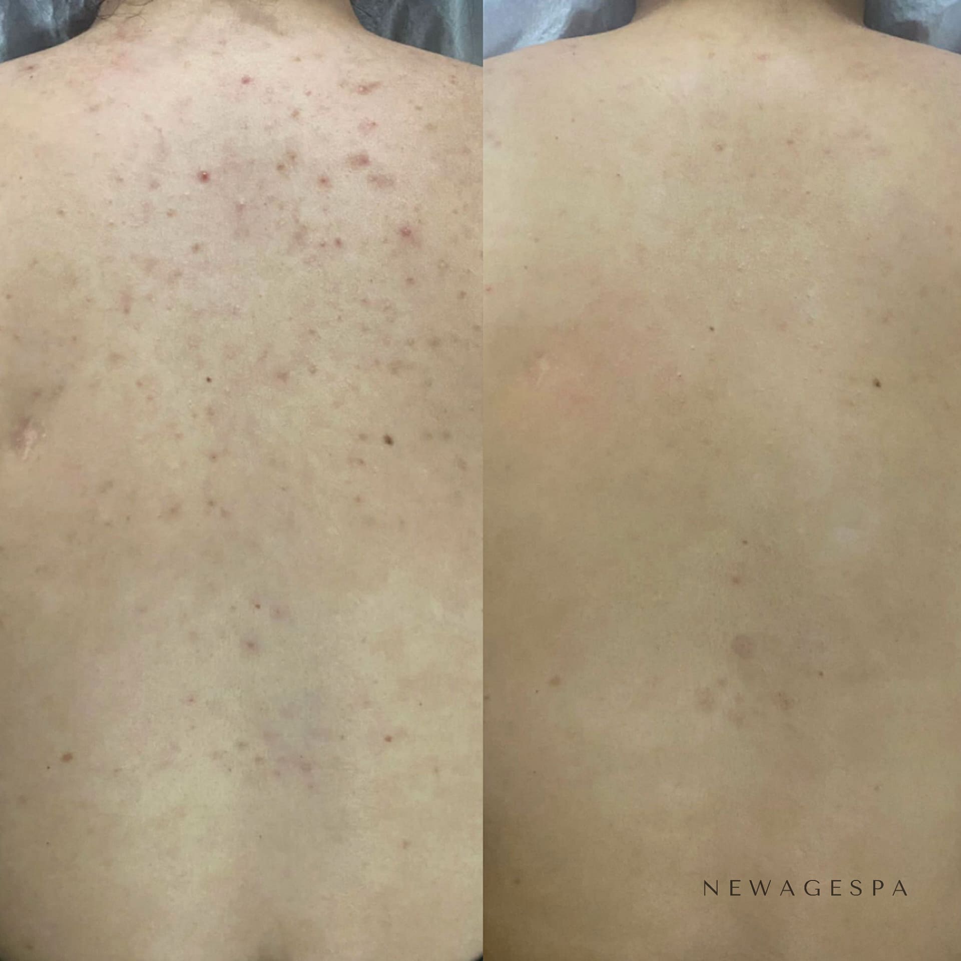 Back Chemical Peel Hover