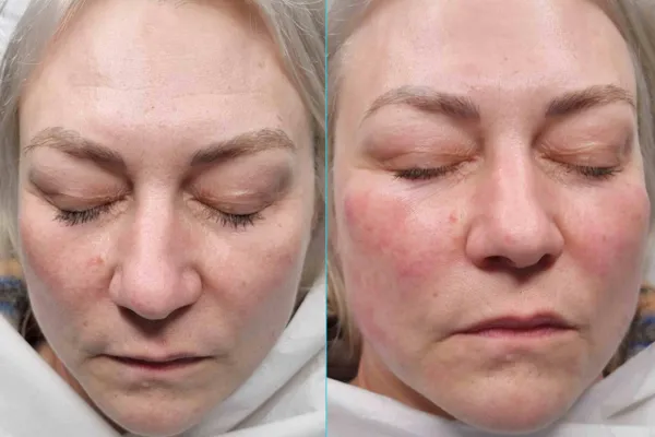 Dior Hydrafacial Hover