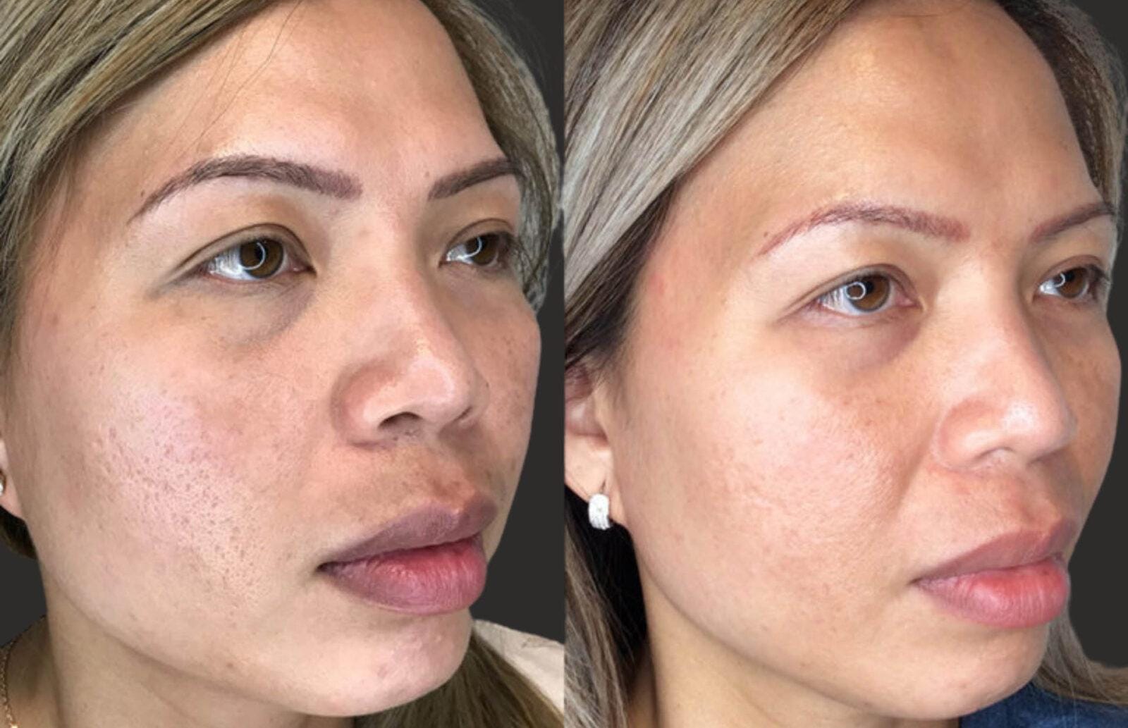 Full Face RF Microneedling Hover