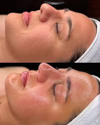 Hydrafacial Skin Booster Hover
