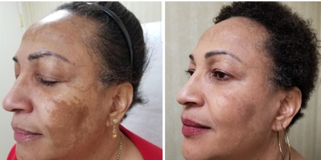 VI Hyperpigmentation Peel Hover