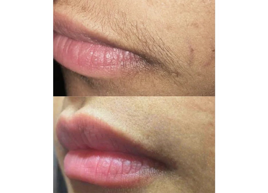 $29 Upper Lip Laser Hair Removal Hover