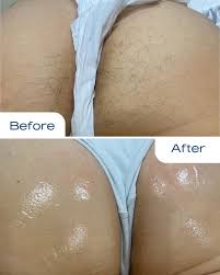 Buttocks Laser Hair Removal Hover