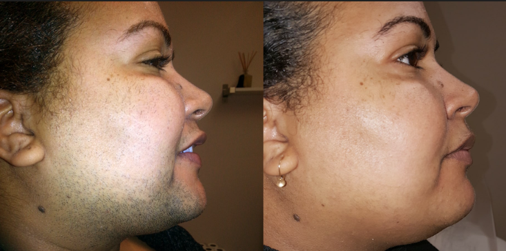 Cheeks Laser Hair Removal Hover