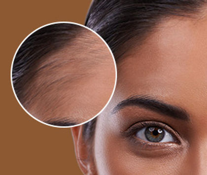 Forehead Laser Hair Removal Hover