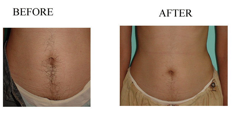 Full Abs Laser Hair Removal Hover