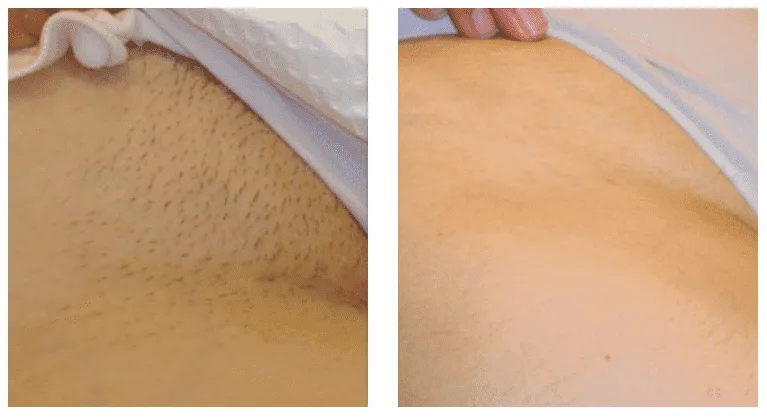 Full Brazilian Laser Hair Removal Hover