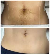 Happy Trail Laser Hair Removal Hover