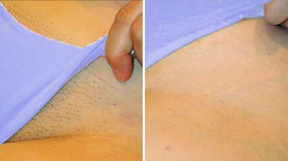 Pantyline Laser Hair Removal Hover