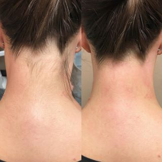 Ponytail Laser Hair Removal Hover