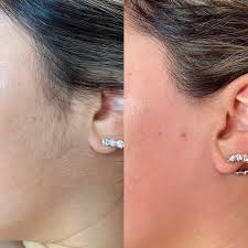 Sideburns Laser Hair Removal Hover