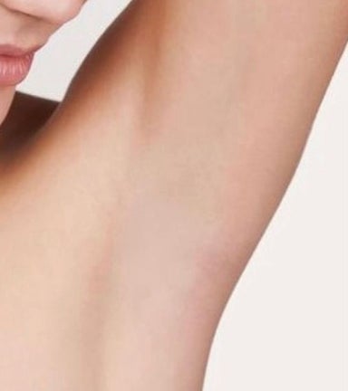 Underarms Laser Hair Removal