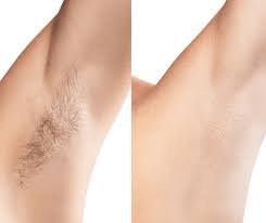 Underarms Laser Hair Removal Hover