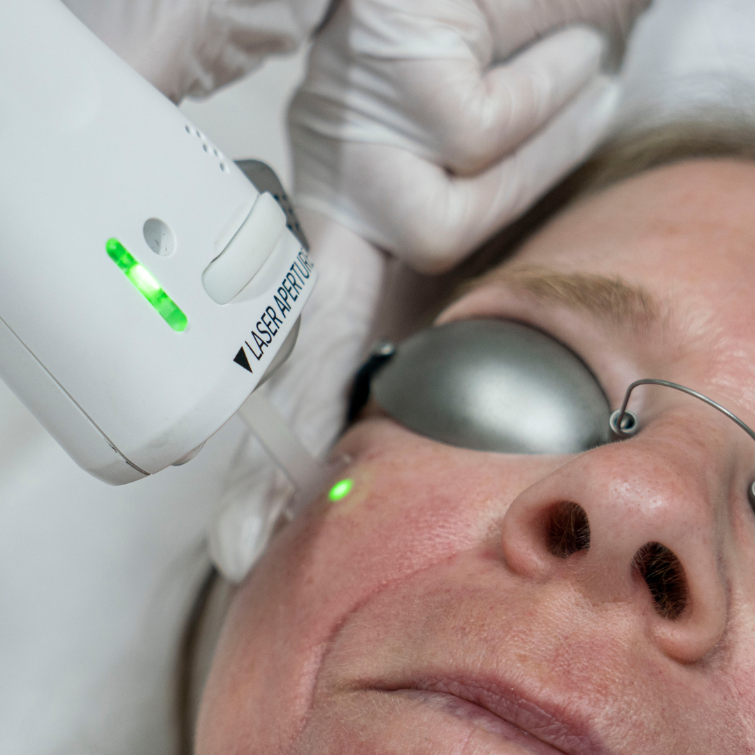 Laser Rosacea Facial