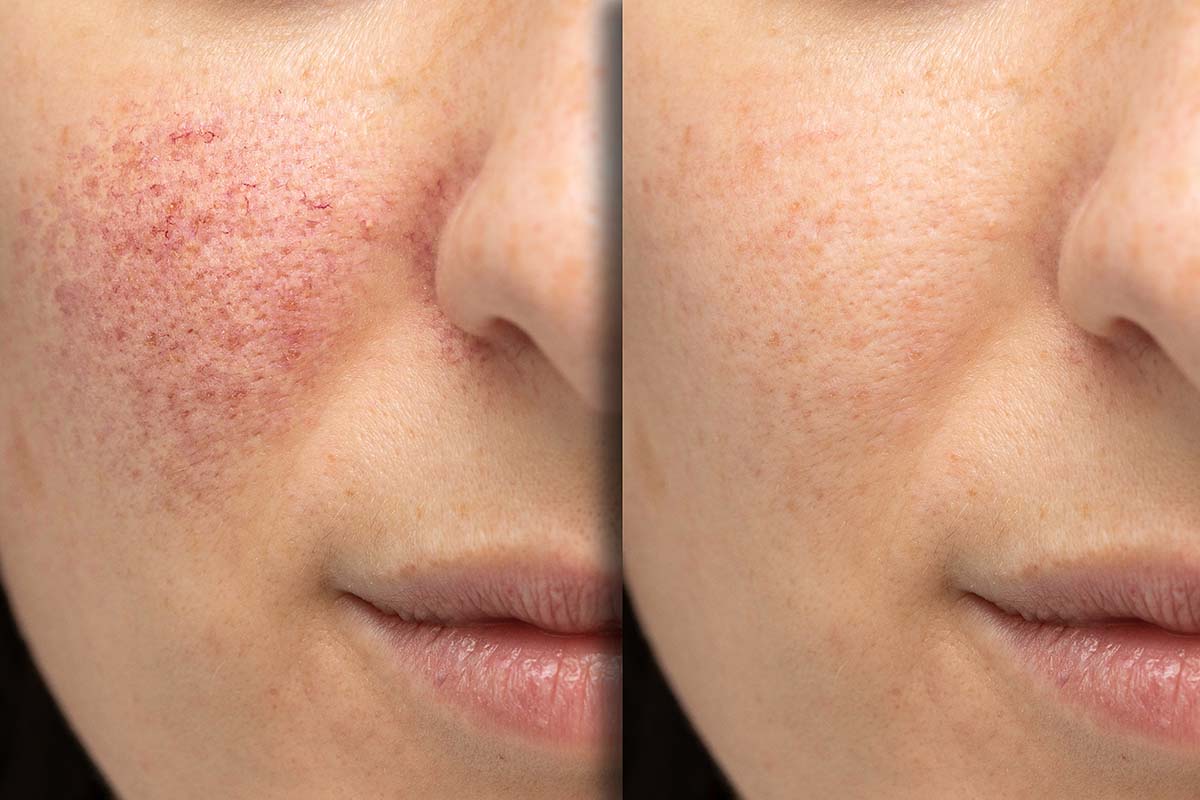 Rosacea Peel Hover